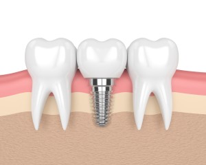 Implantologie au cabinet dentaire du Dr Vermot à Besançon (25)