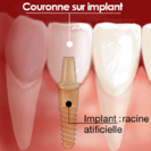Qu'est-ce qu'un implant dentaire ? Indications et contre-indications du cabinet dentaire du Dr Vermot à Besançon